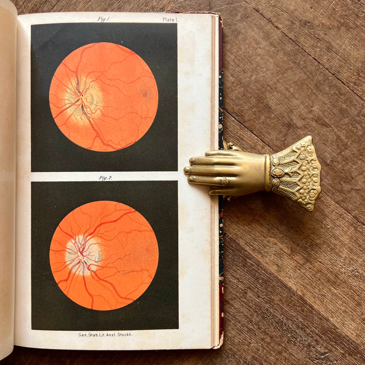 The Ophthalmoscope and Lues (1884) – Ole B. Bull M. D.